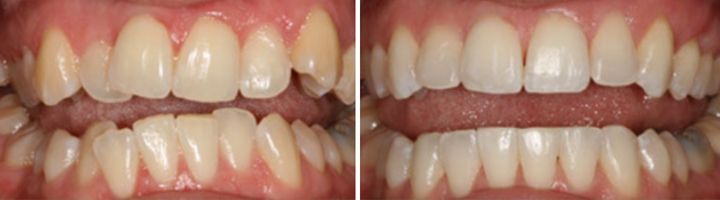 Before and after dental treatment showing tooth whitening and alignment results