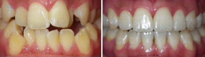 Before and after orthodontic treatment showing improved tooth alignment and spacing