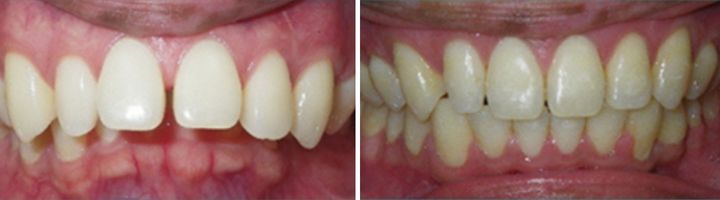Before and after orthodontic treatment showing improved upper and lower teeth positioning