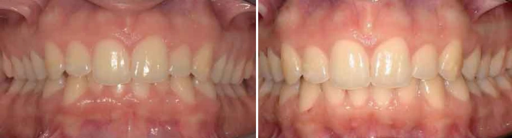 Before and after orthodontic treatment showing corrected bite and tooth positioning