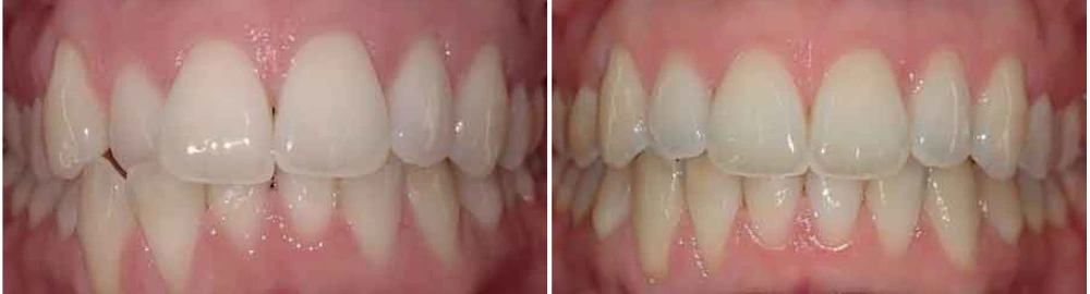 Before and after dental restoration with whitened front teeth and improved alignment