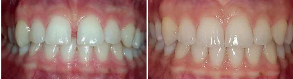 Before and after dental treatment showing teeth with improved alignment and whiteness
