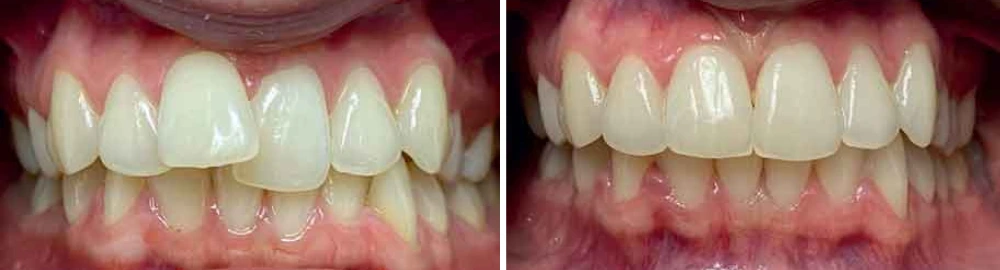Before and after dental case with corrected tooth spacing and enhanced smile aesthetics