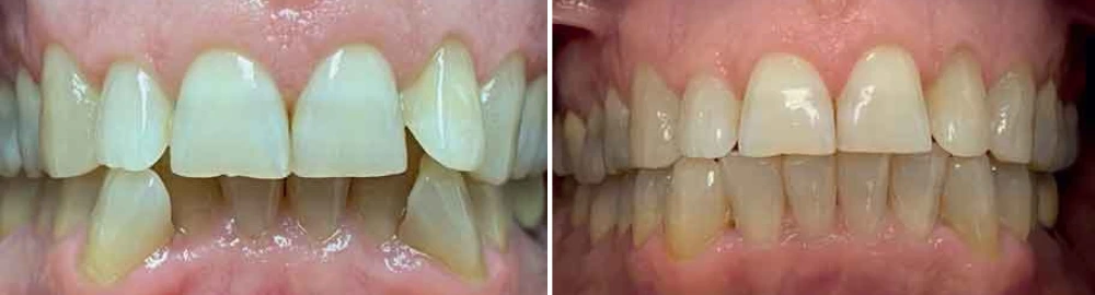 Before and after dental treatment showing straightened upper and lower teeth